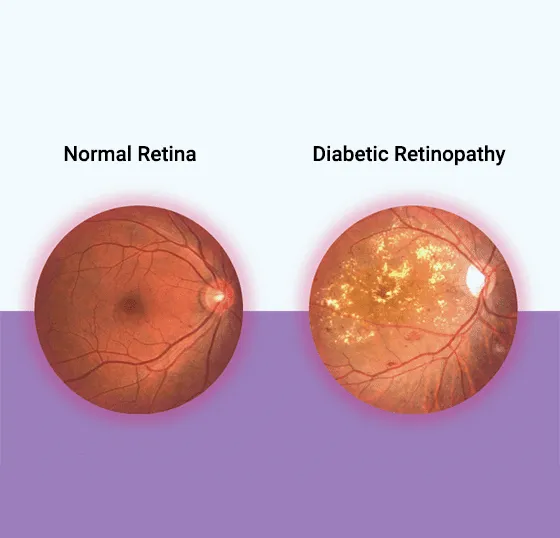 Normal retina compared with diabetic retinopathy